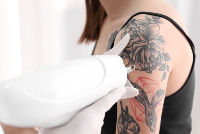 enlever-un-tatouage-definitivement