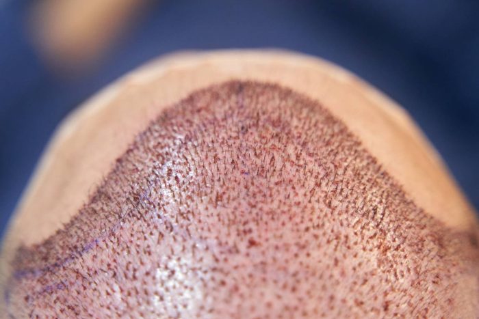 greffe-de-cheveux-fait-mal