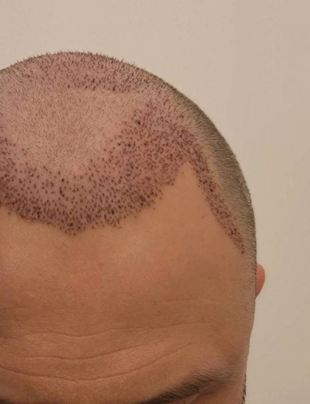 la-greffe-de-cheveux-sans-cicatrice