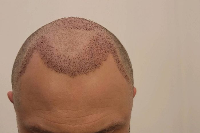 la-greffe-de-cheveux-sans-cicatrice