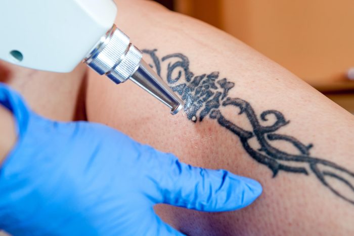 laser-pigmentair-pour-enlever-un-tatouage