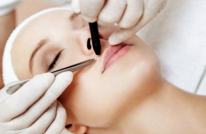 epilation-electrolyse